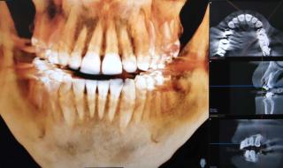 cbct